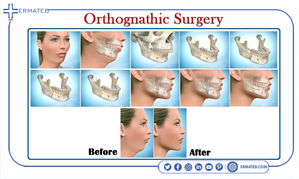 orthognathic surgery and jawline surgery